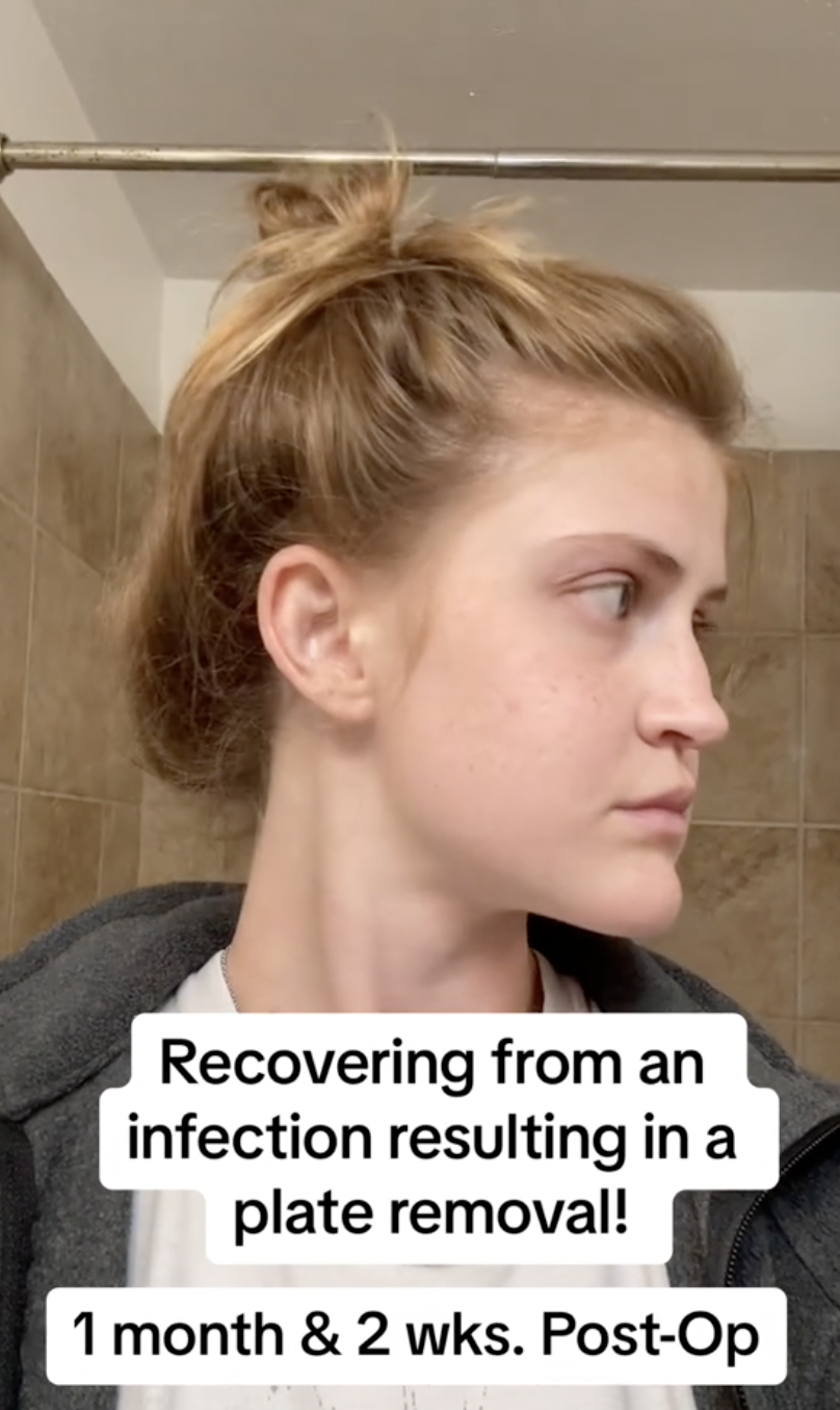 Virginia Elder se gira hacia un lado, mostrando la estructura de su mandíbula en proceso de curación | Fuente: TikTok/virginiaeelder