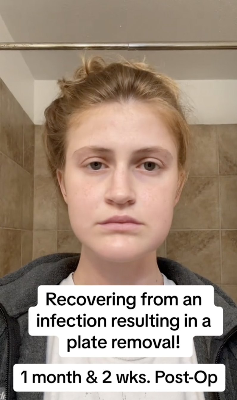 Virginia Elder muestra un rostro inexpresivo, documentando los estragos de su proceso de recuperación | Fuente: TikTok/virginiaeelder