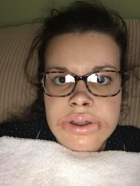 Un primer plano de Katie Wolferding tras la operación, de junio de 2019 | Fuente: Facebook/katiewolferding