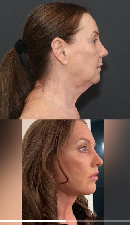 Vistas de perfil lado a lado que muestran los resultados del lifting facial plano profundo y el lifting de cuello de Tina Heaton, compartidos por el Dr. Mike Nayak en respuesta a la incredulidad en Internet. | Fuente: TikTok/nayakplasticsurgery