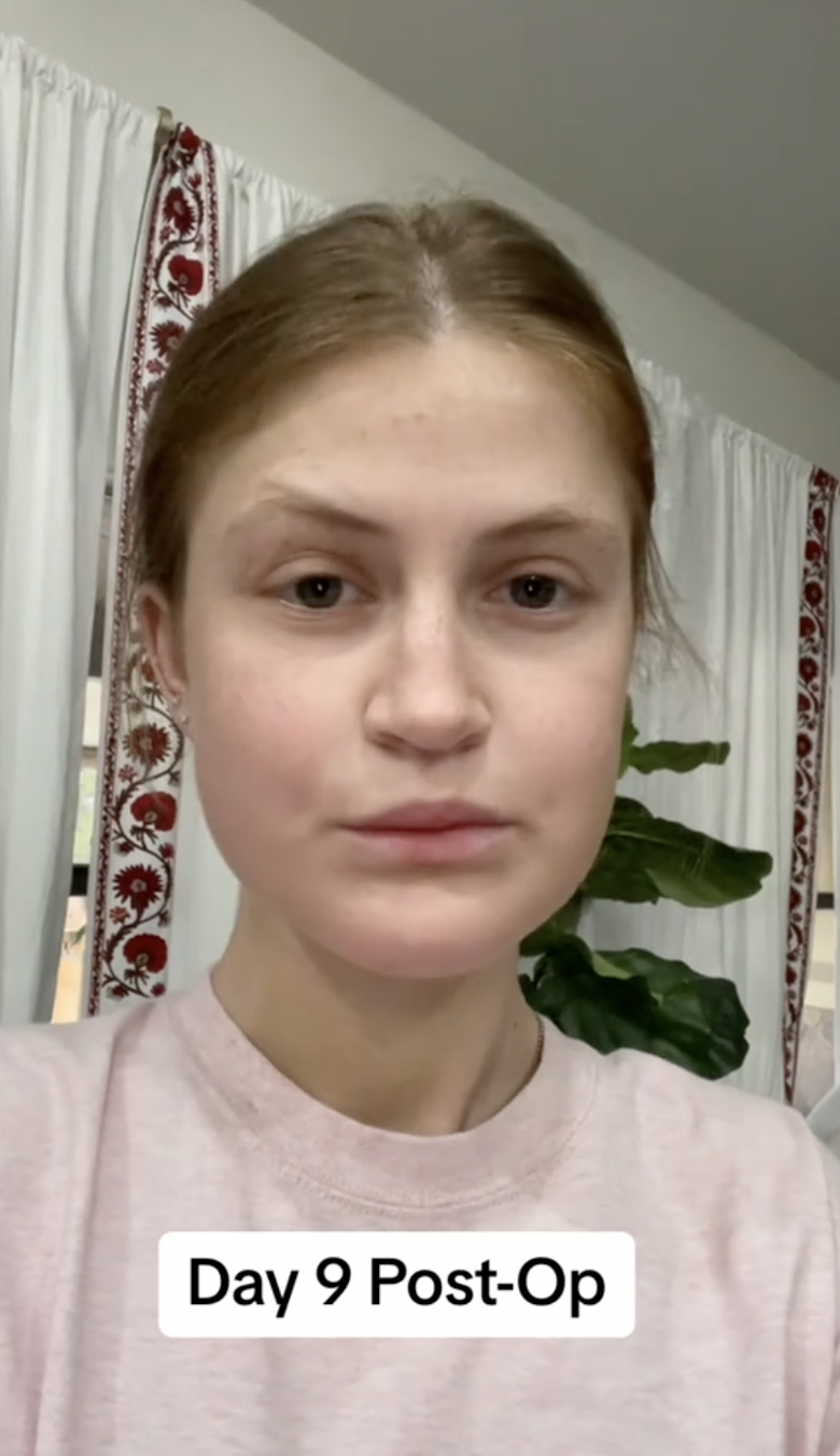 Virginia Elder publica una foto de frente en el día 9 con sutiles progresos en la curación | Fuente: TikTok/virginiaeelder