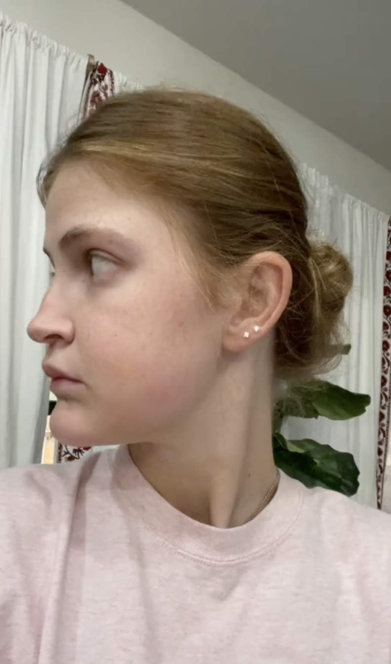 Ángulo lateral de Virginia Elder en el día 9 postoperatorio, que muestra el desarrollo de la simetría facial | Fuente: TikTok/virginiaeelder