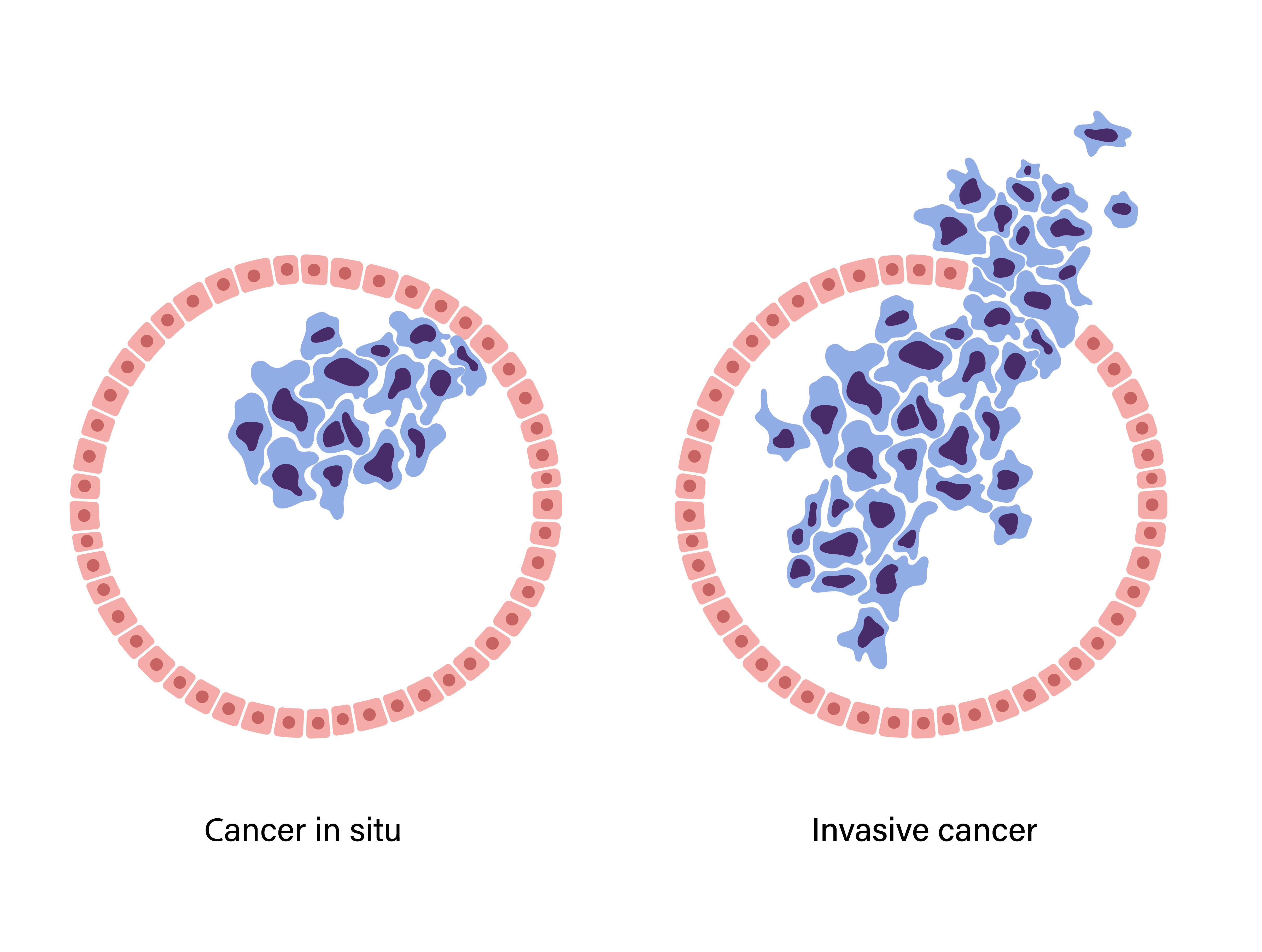 Representación visual de cómo se forman y propagan las células del cáncer de mama en el tejido mamario | Fuente: Getty Images