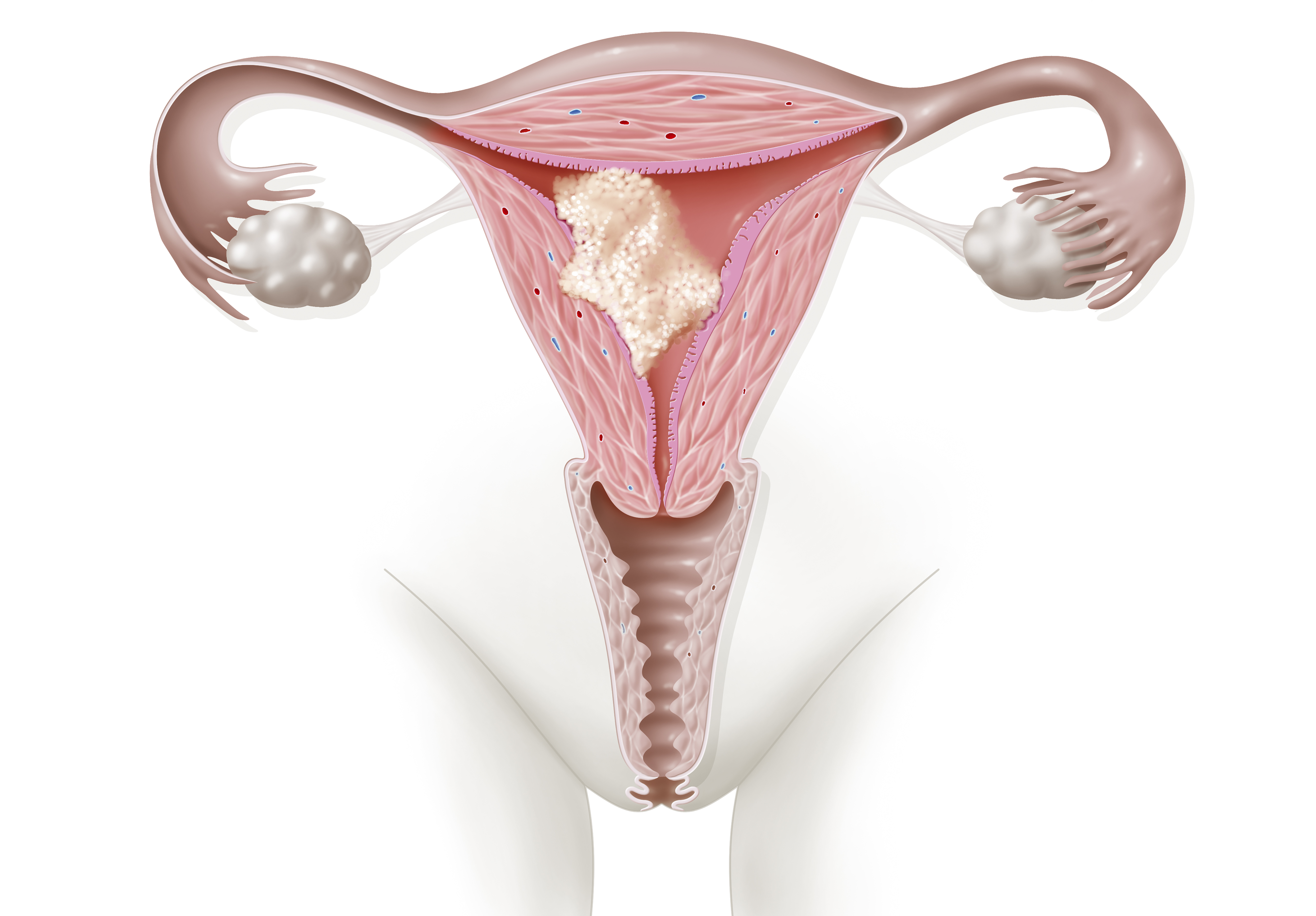 Ilustración de un cáncer de endometrio (uterino) que muestra un tumor que se ha extendido al músculo uterino pero que aún no ha llegado al cuello uterino | Fuente: Getty Images