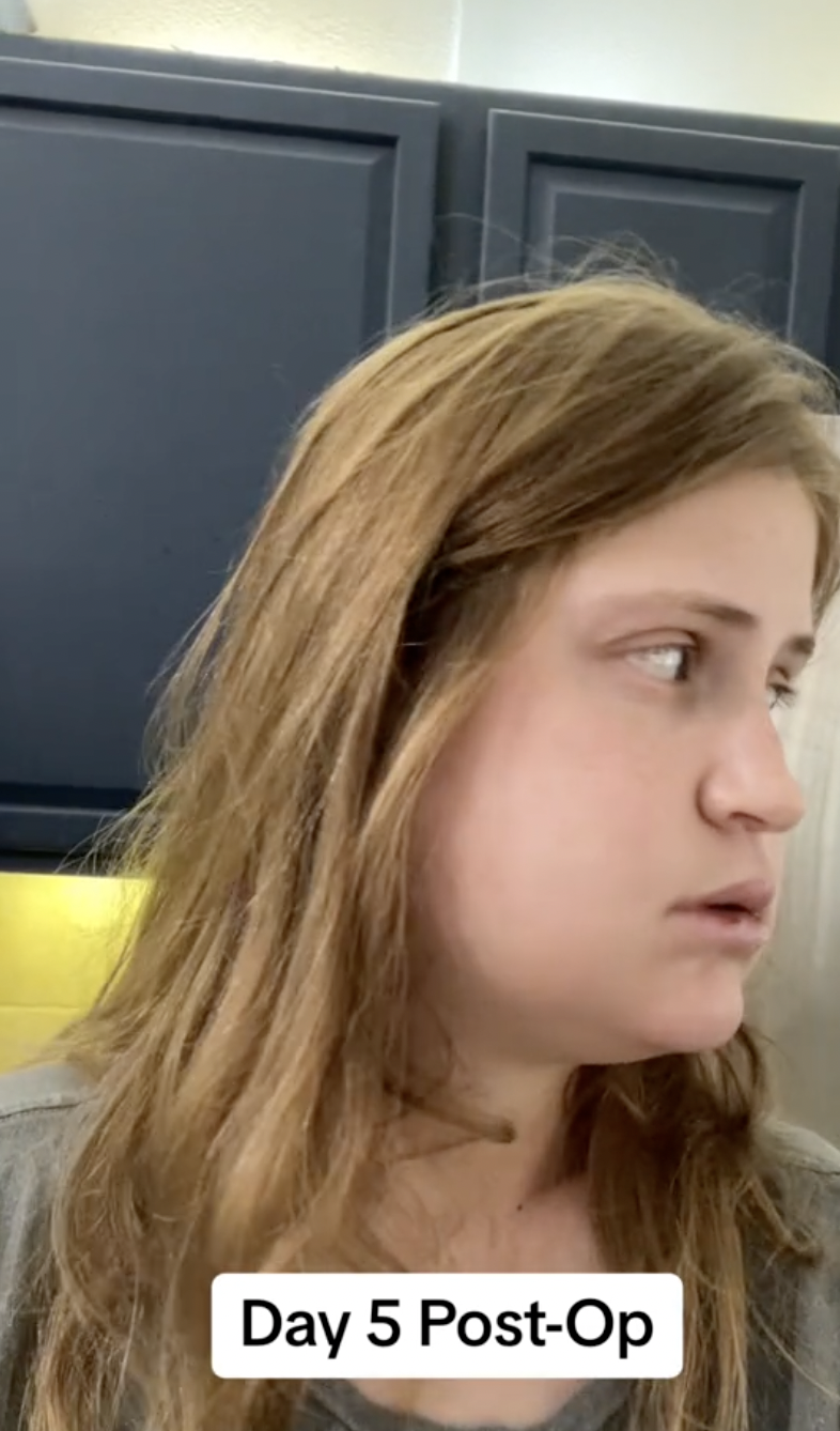 Perfil lateral de Virginia Elder mientras se adapta a su nueva alineación mandibular | Fuente: TikTok/virginiaeelder