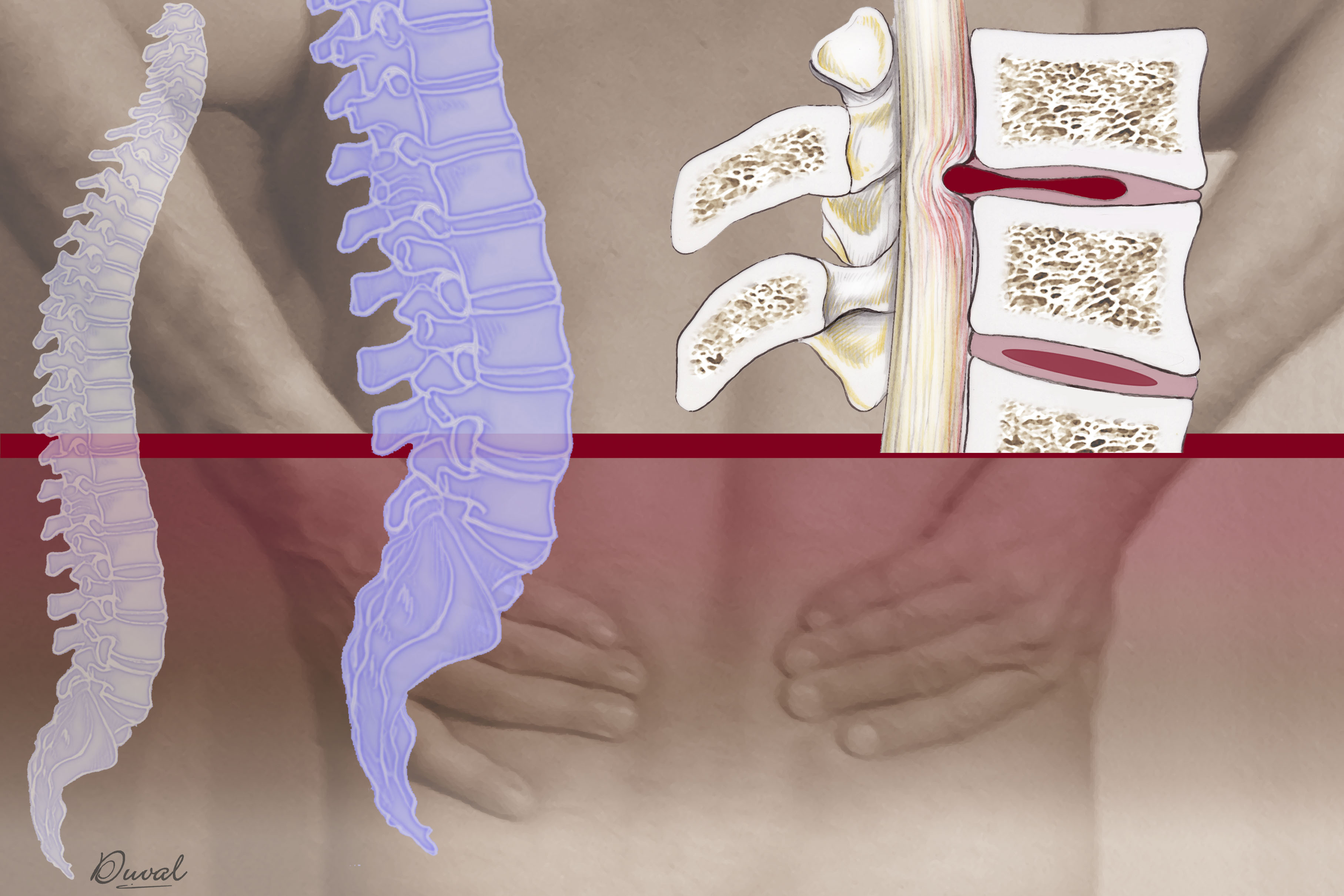 Ilustración de una hernia discal | Fuente: Getty Images
