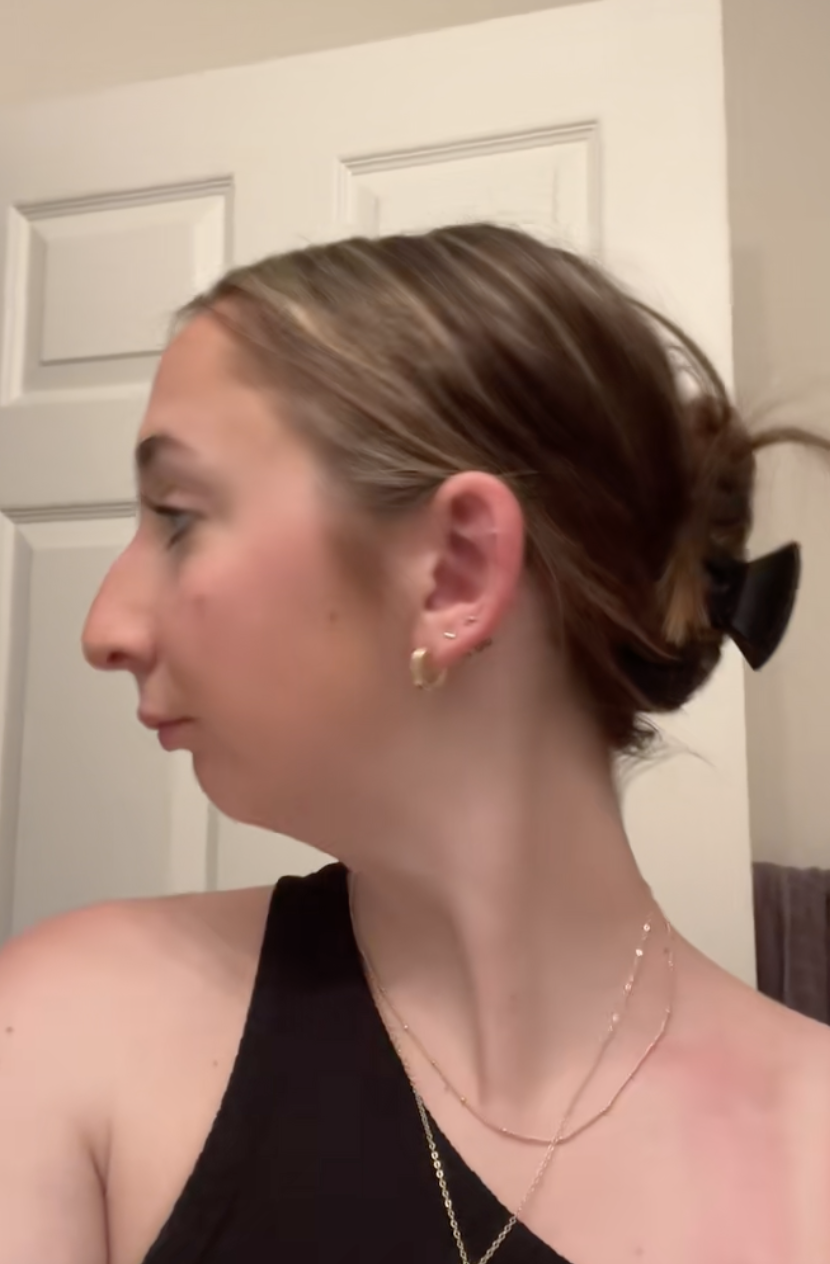 Maddie antes de someterse a una operación de doble mandíbula de un post fechado el 2 de agosto de 2023. | Fuente: TikTok/maddieakamofo