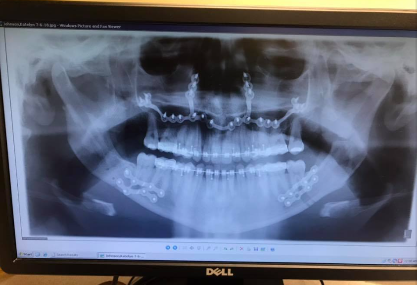 Radiografía de Katie Wolferding, fechada en junio de 2019 | Fuente: Facebook/katiewolferding