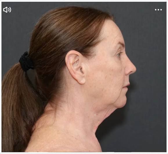 Perfil lateral de Tina Heaton antes de la operación, con piel flácida visible a lo largo del cuello y la mandíbula. | Fuente: TikTok/nayakplasticsurgery