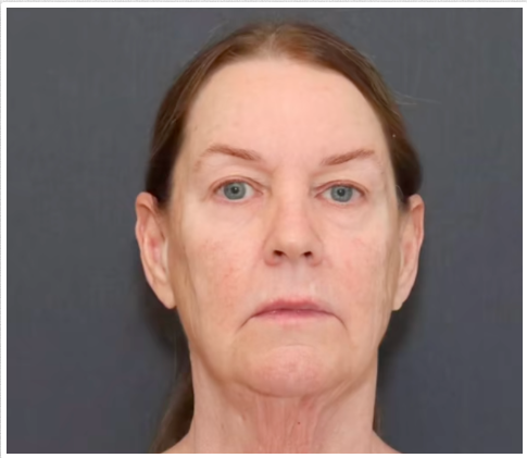 Tina Heaton antes de someterse a un rejuvenecimiento facial completo. | Fuente: TikTok/cirugía plástica Nayak