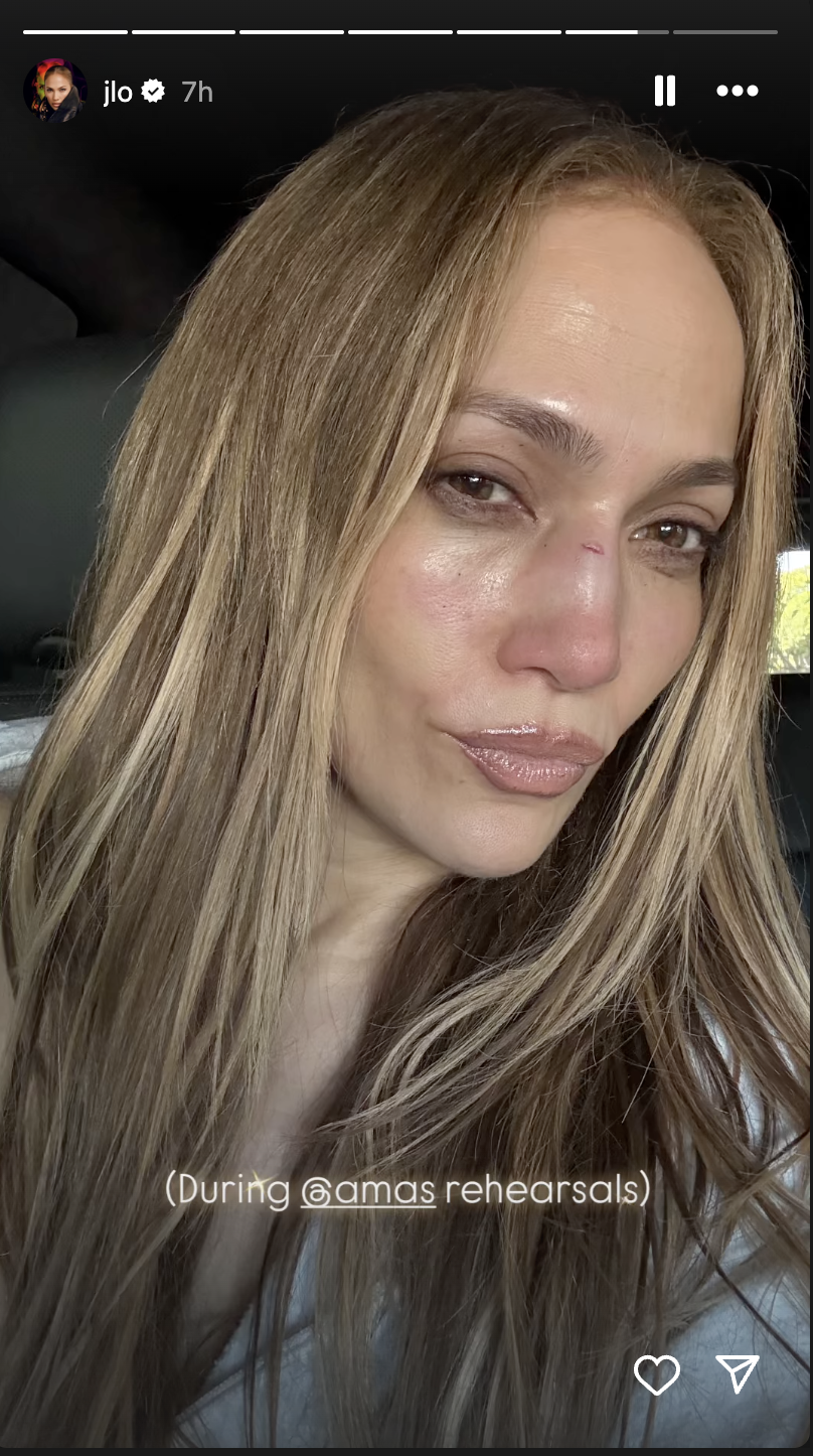 Jennifer Lopez con un corte en el puente de la nariz, publicado en sus historias de Instagram el 13 de mayo de 2025 | Fuente: Instagram/jlo