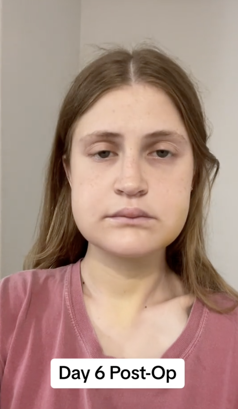 Virginia Elder documenta el día 6 postoperatorio con un selfie centrada y quieta | Fuente: TikTok/virginiaeelder