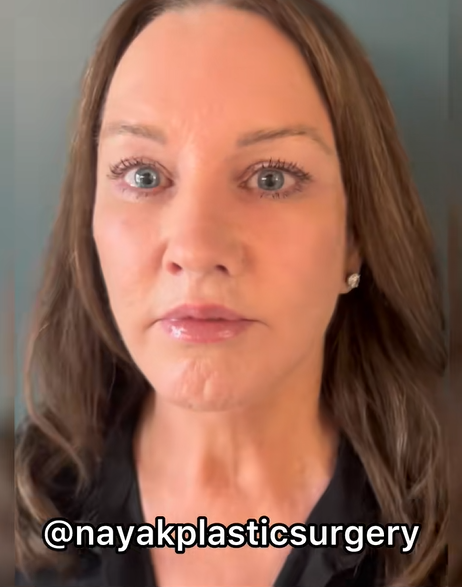 Imagen postoperatoria de frente de Tina Heaton, publicada por el Dr. Mike Nayak para confirmar la legitimidad de los resultados de su rejuvenecimiento facial. | Fuente: TikTok/cirugíaplástica Nayak