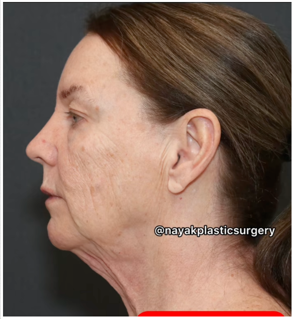 Otro ángulo anterior a la cirugía que muestra la laxitud de la piel facial y la formación de papada de Tina Heaton. | Fuente: TikTok/nayakplasticsurgery
