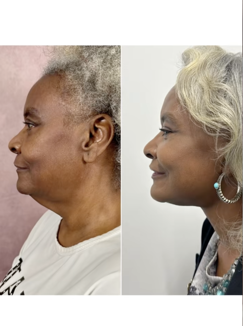 Una captura de pantalla de Linda Truesdale antes y después de hacerse un lifting facial de un post fechado el 27 de febrero de 2025. | Fuente: TikTok/doctor.truesdale