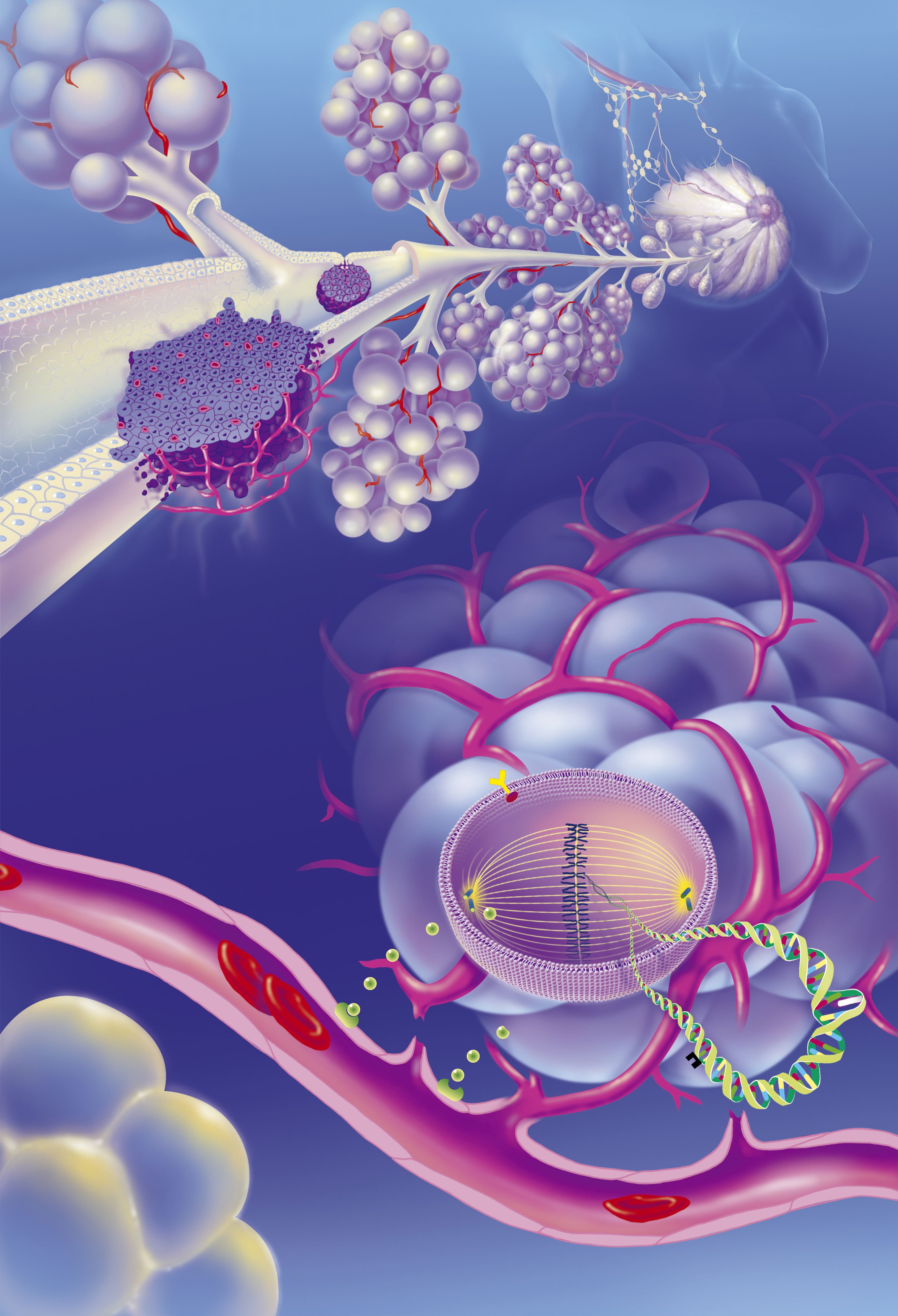 Ilustración médica que muestra carcinomas ductales invasivos e in situ. La imagen traza un zoom desde la glándula mamaria hasta el conducto galactóforo, resaltando la localización del tumor, la estructura glandular y los ganglios linfáticos axilares | Fuente: Getty Images
