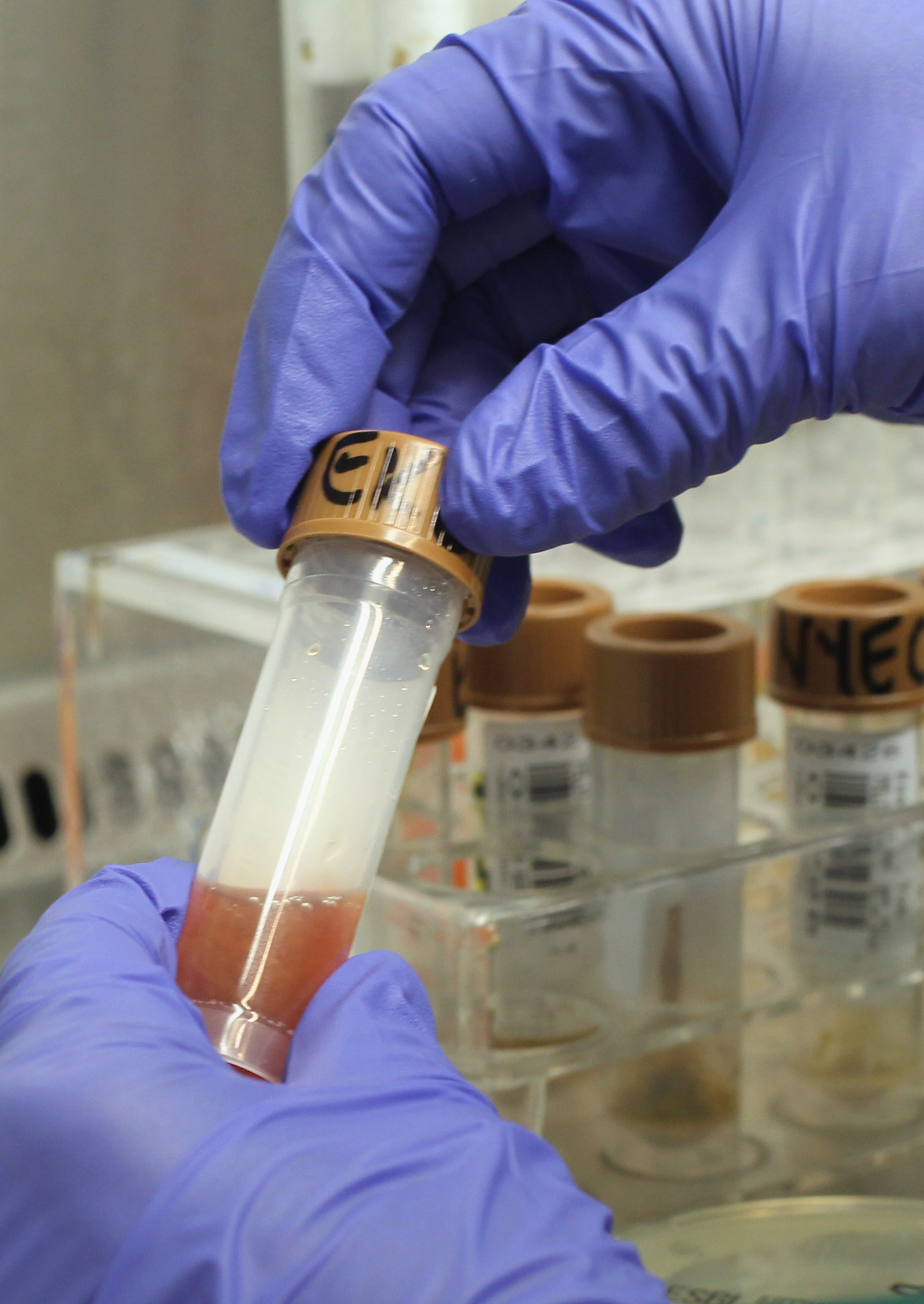 Un técnico de laboratorio abre una muestra de heces ensangrentadas tomada a un paciente | Fuente: Getty Images