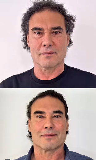 Antes y después del tratamiento de rejuvenecimiento que se hizo Eduardo Yáñez. | Fuente: Instagram/eduardoyanezofc.