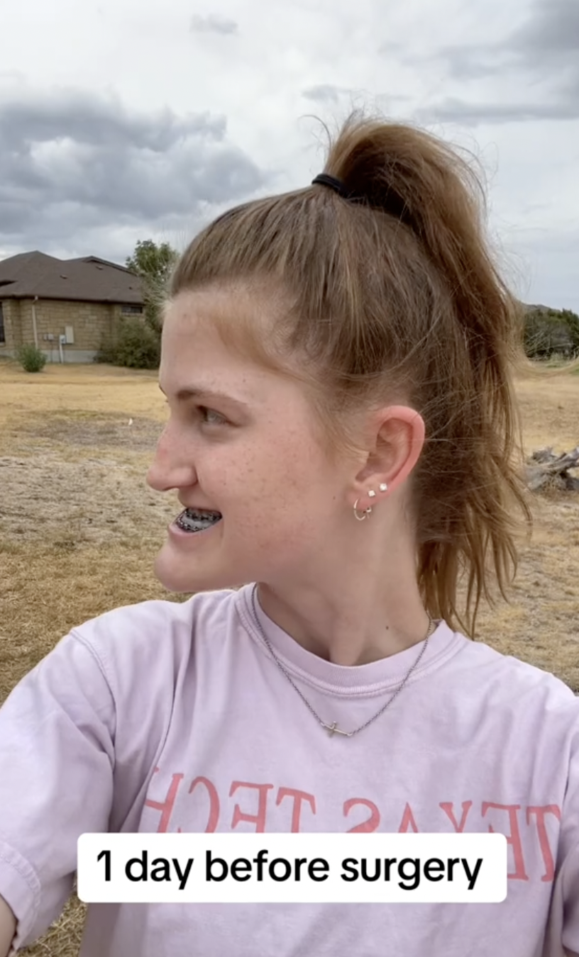 Perfil lateral de Virginia Elder un día antes de la operación, que muestra la alineación natural de su mandíbula | Fuente: TikTok/virginiaeelder