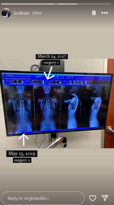 Dos grandes operaciones de columna -en 2017 y 2019- ayudaron a Virginia Elder a estabilizar su escoliosis con un hardware extenso | Fuente: Instagram/virginiaelder
