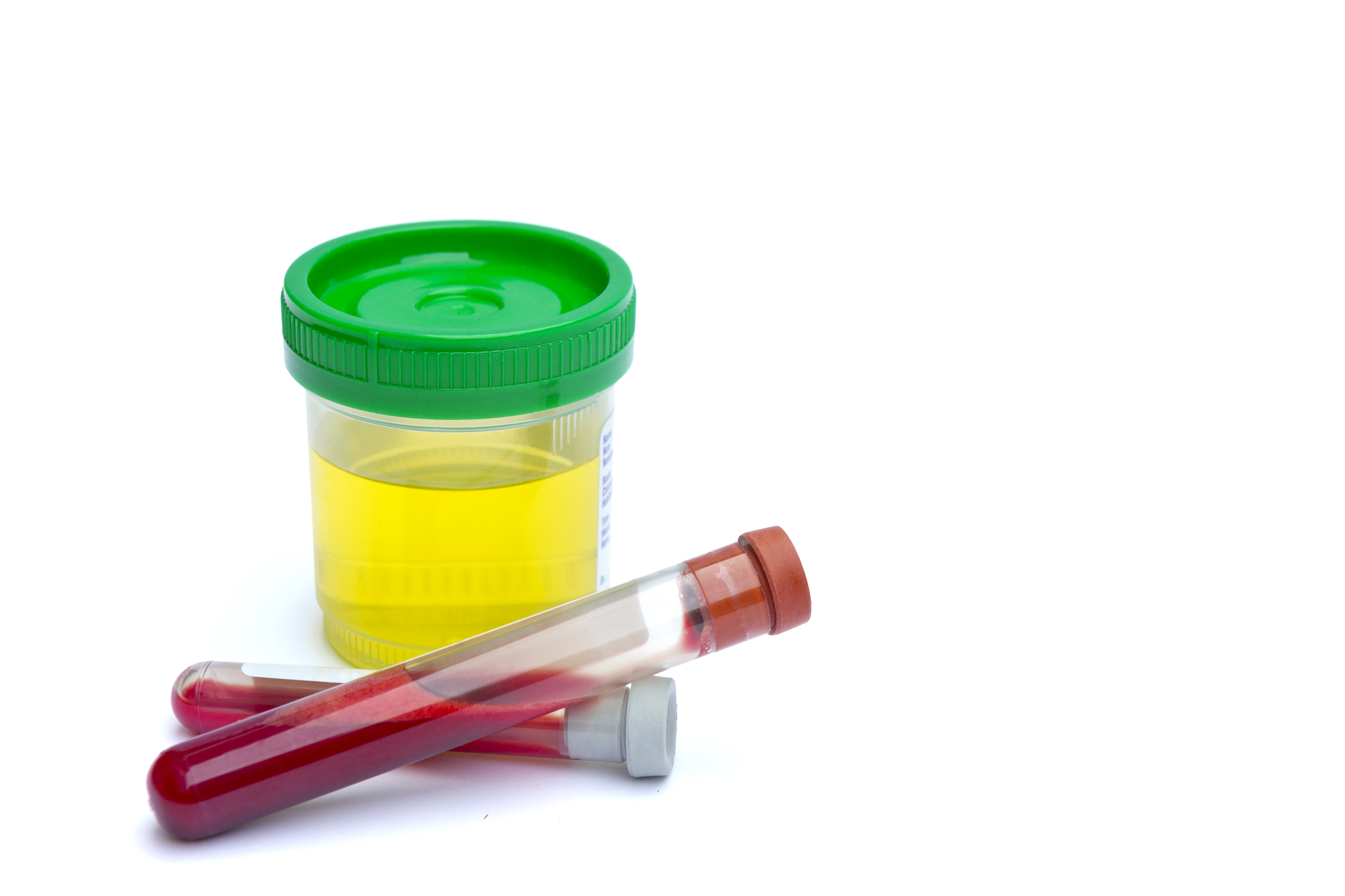 Viales estériles para muestras de orina y análisis de sangre en un entorno clínico | Fuente: Getty Images