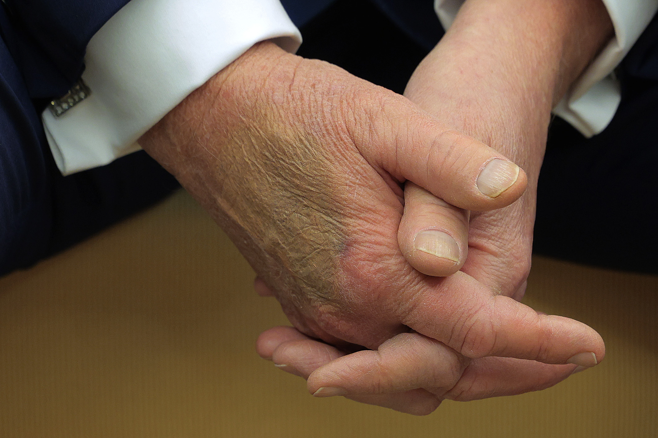 El maquillaje cubre un moratón en el dorso de la mano del presidente estadounidense Donald Trump mientras recibe al presidente francés Emmanuel Macron para reunirse en la Casa Blanca el 24 de febrero de 2025 en Washington, DC | Fuente: Getty Images