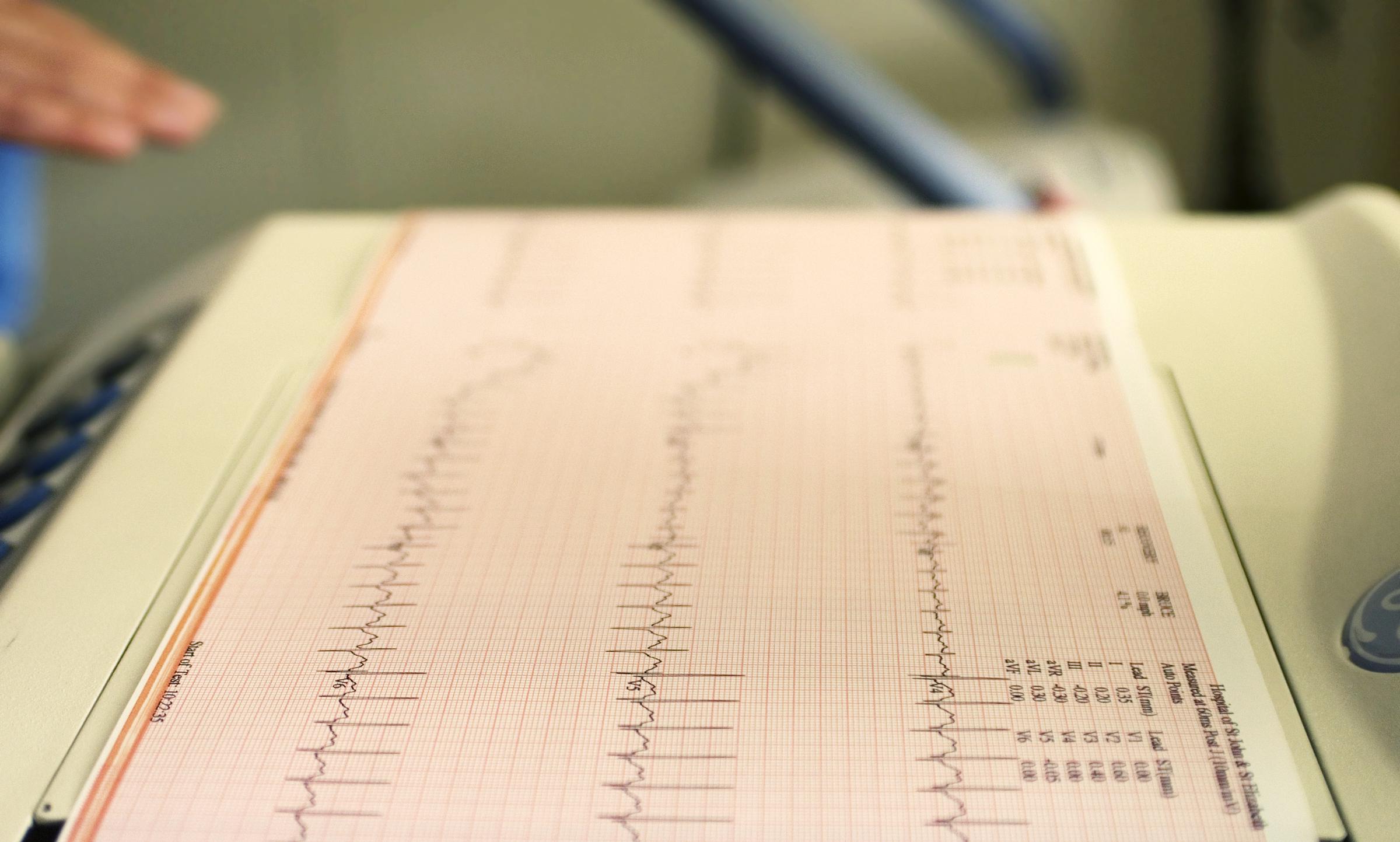 Registro del ciclo cardiaco de un paciente producido por un electrocardiógrafo | Fuente: Getty Images