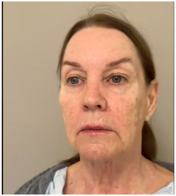 Tina Heaton, antes de la operación, mostrando una visible pérdida de volumen facial y los primeros signos de envejecimiento. | Fuente: TikTok/nayakplasticsurgery