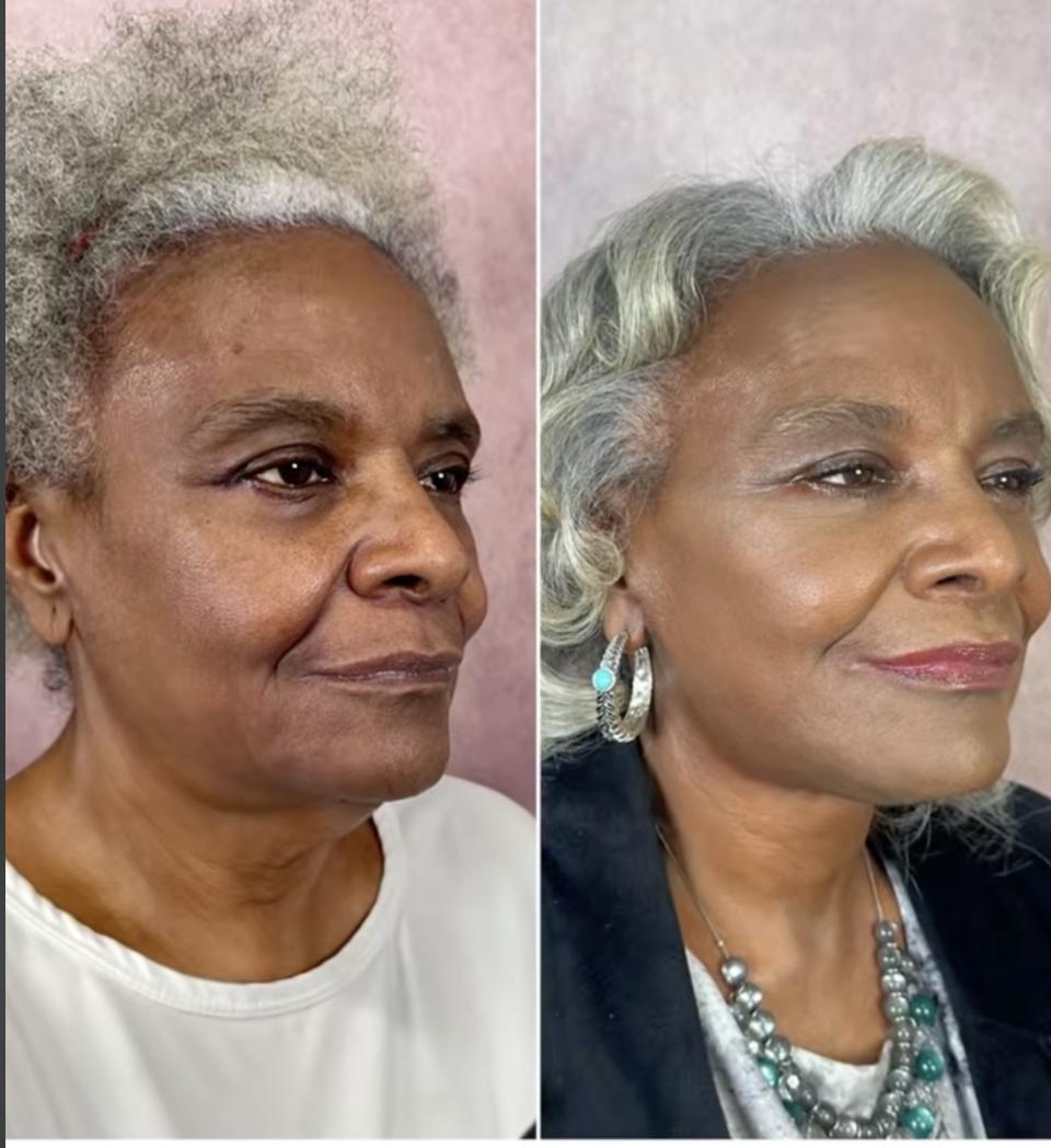 Una captura de pantalla de Linda Truesdale antes y después de hacerse un lifting facial de un post fechado el 27 de febrero de 2025. | Fuente: TikTok/doctor.truesdale