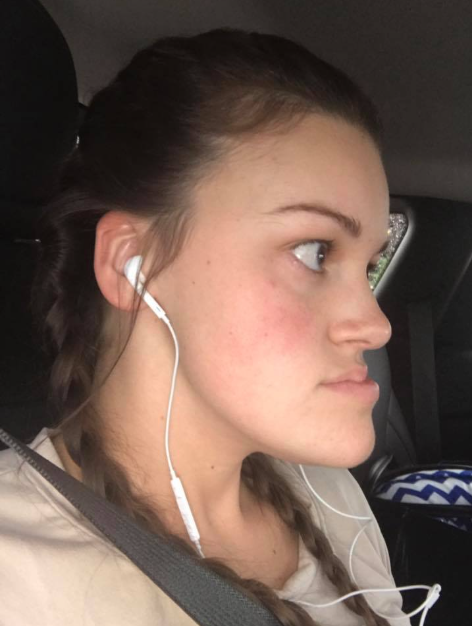 Vista lateral de la mandíbula de Katie Wolferding, con fecha de junio de 2019 | Fuente: Facebook/katiewolferding