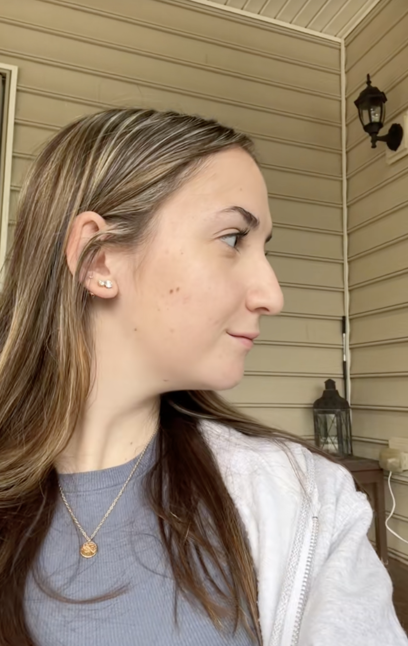 Maddie tras someterse a una operación de doble mandíbula de un post fechado el 2 de agosto de 2023. | Fuente: TikTok/maddieakamofo