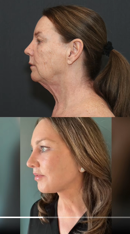 Comparación del perfil antes y después de Tina Heaton, compartida por el Dr. Mike Nayak para abordar el escepticismo público sobre la autenticidad de su transformación. | Fuente: TikTok/nayakplasticsurgery