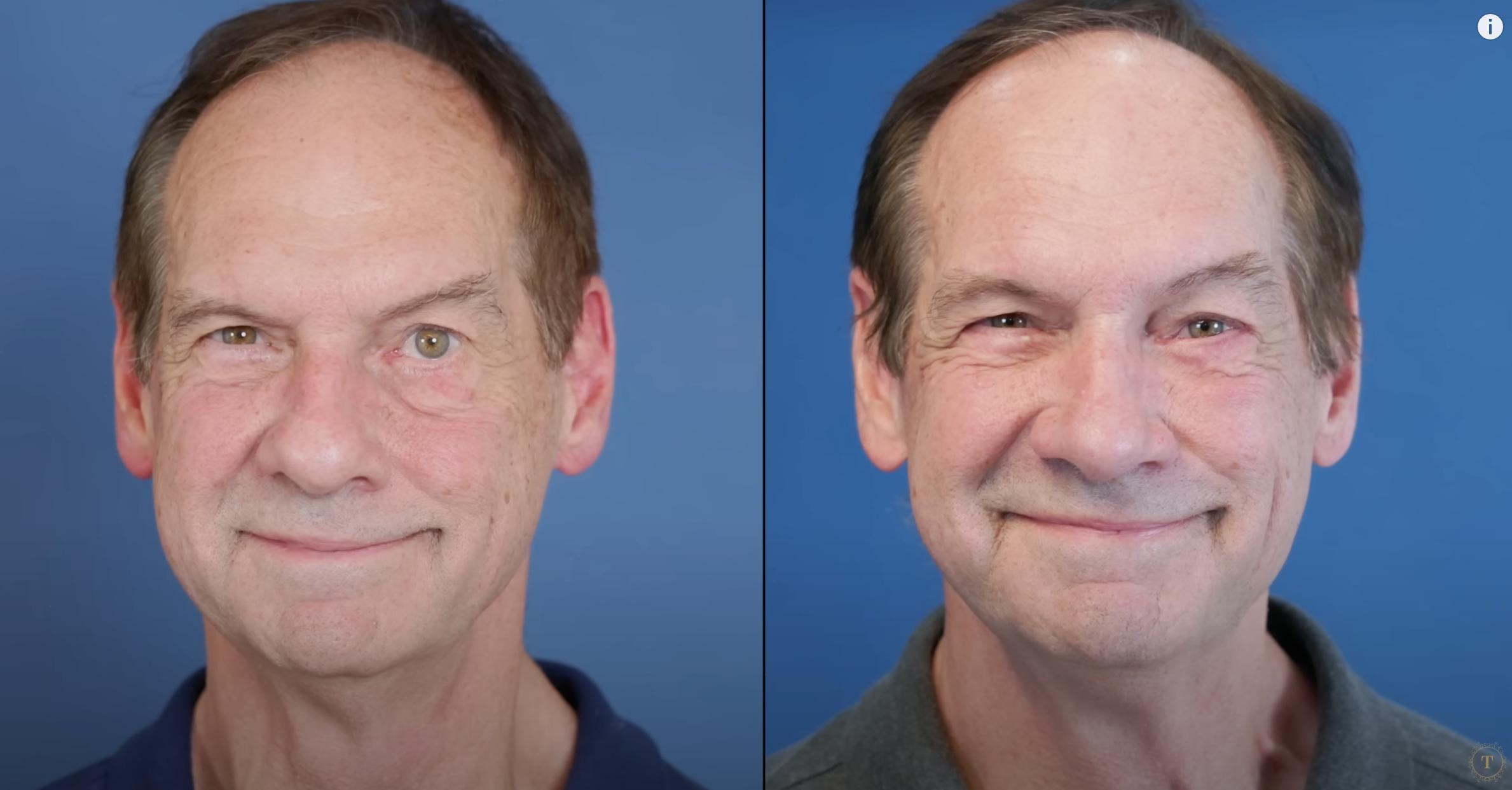 Barry Wolf antes y después de la operación | Fuente: YouTube/@Dr.Truesdale